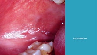 LEUCOEDEMA
 