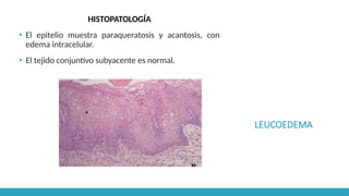 LEUCOEDEMA
HISTOPATOLOGÍA
▪ El epitelio muestra paraqueratosis y acantosis, con
edema intracelular.
▪ El tejido conjuntivo subyacente es normal.
 