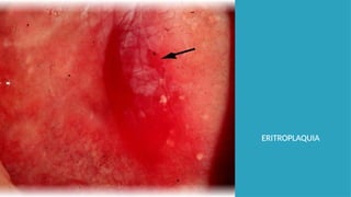 ERITROPLAQUIA
 
