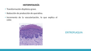 ERITROPLAQUIA
HISTOPATOLOGÍA
▪ Transformación displásica grave.
▪ Reducción de producción de queratina.
▪ Incremento de la vascularización, lo que explica el
color.
 
