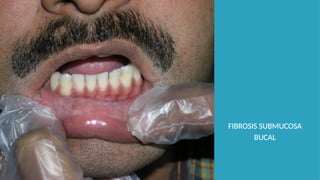 FIBROSIS SUBMUCOSA
BUCAL
 