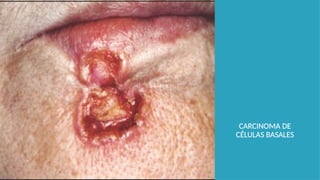 CARCINOMA DE
CÉLULAS BASALES
 