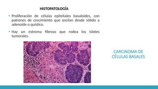 CARCINOMA DE
CÉLULAS BASALES
HISTOPATOLOGÍA
▪ Proliferación de células epiteliales basaloides, con
patrones de crecimiento que oscilan desde sólido a
adenoide o quístico.
▪ Hay un estroma fibroso que rodea los islotes
tumorales.
 