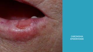 CARCINOMA
EPIDERMOIDE
 