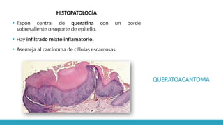 QUERATOACANTOMA
HISTOPATOLOGÍA
▪ Tapón central de queratina con un borde
sobresaliente o soporte de epitelio.
▪ Hay infiltrado mixto inflamatorio.
▪ Asemeja al carcinoma de células escamosas.
 