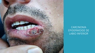 CARCINOMA
EPIDERMOIDE DE
LABIO INFERIOR
 