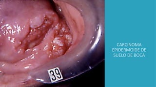 CARCINOMA
EPIDERMOIDE DE
SUELO DE BOCA
 
