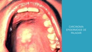 CARCINOMA
EPIDERMOIDE DE
PALADAR
 