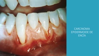 CARCINOMA
EPIDERMOIDE DE
ENCÍA
 