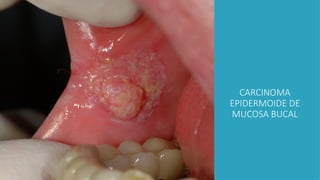 CARCINOMA
EPIDERMOIDE DE
MUCOSA BUCAL
 