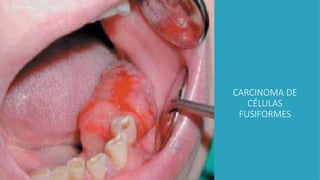 CARCINOMA DE
CÉLULAS
FUSIFORMES
 