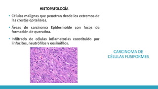 CARCINOMA DE
CÉLULAS FUSIFORMES
HISTOPATOLOGÍA
▪ Células malignas que penetran desde los extremos de
las crestas epiteliales.
▪ Áreas de carcinoma Epidermoide con focos de
formación de queratina.
▪ Infiltrado de células inflamatorias constituido por
linfocitos, neutrófilos y eosinófilos.
 
