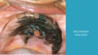 MELANOMA
MALIGNO
 