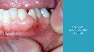 FIBROMA
ODONTÓGENO
CENTRAL
 