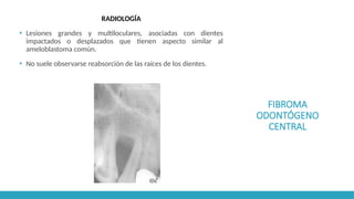 FIBROMA
ODONTÓGENO
CENTRAL
RADIOLOGÍA
▪ Lesiones grandes y multiloculares, asociadas con dientes
impactados o desplazados que tienen aspecto similar al
ameloblastoma común.
▪ No suele observarse reabsorción de las raíces de los dientes.
 