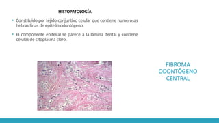FIBROMA
ODONTÓGENO
CENTRAL
HISTOPATOLOGÍA
▪ Constituido por tejido conjuntivo celular que contiene numerosas
hebras finas de epitelio odontógeno.
▪ El componente epitelial se parece a la lámina dental y contiene
células de citoplasma claro.
 