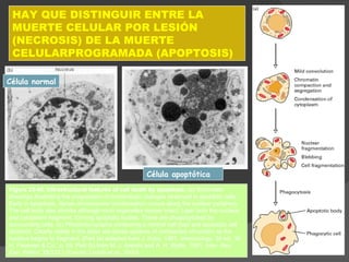 Figure 23-45. Ultrastructural features of cell death by apoptosis.  (a) Schematic drawings illustrating the progression of morphologic changes observed in apoptotic cells. Early in apoptosis, dense chromosome condensation occurs along the nuclear periphery. The cell body also shrinks although most organelles remain intact. Later both the nucleus and cytoplasm fragment, forming apoptotic bodies. These are phagocytosed by surrounding cells. (b) Photomicrographs comparing a normal cell  (top)  and apoptotic cell  (bottom).  Clearly visible in the latter are dense spheres of compacted chromatin as the nucleus begins to fragment. [Part (a) adapted from J. Kuby, 1997,  Immunology,  3d ed., W. H. Freeman & Co., p. 53. Part (b) from M. J. Arends and A. H. Wyllie, 1991,  Inter.  Rev. Exp. Pathol.   32: 223.]  (Fuente: Lodish et al., 2000) HAY QUE DISTINGUIR ENTRE LA MUERTE CELULAR POR LESIÓN (NECROSIS) DE LA MUERTE CELULARPROGRAMADA (APOPTOSIS) Célula apoptótica Célula normal 