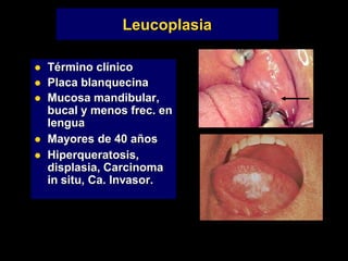 Leucoplasia
 Término clínico
 Placa blanquecina
 Mucosa mandibular,
bucal y menos frec. en
lengua
 Mayores de 40 años
 Hiperqueratosis,
displasia, Carcinoma
in situ, Ca. Invasor.
 