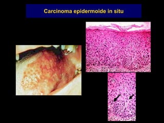 Carcinoma epidermoide in situ
 