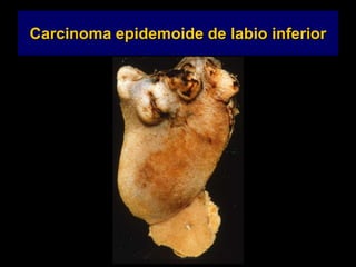 Carcinoma epidemoide de labio inferior
 