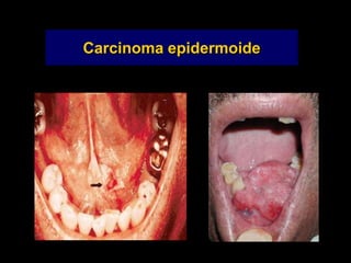 Carcinoma epidermoide
 