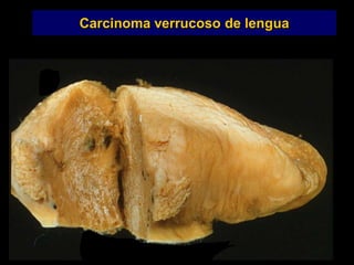 Carcinoma verrucoso de lengua
 