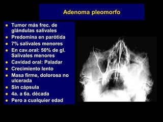 Adenoma pleomorfo
 Tumor más frec. de
glándulas salivales
 Predomina en parótida
 7% salivales menores
 En cav.oral: 50% de gl.
Salivales menores
 Cavidad oral: Paladar
 Crecimiento lento
 Masa firme, dolorosa no
ulcerada
 Sin cápsula
 4a. a 6a. década
 Pero a cualquier edad
 