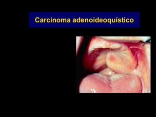 Carcinoma adenoideoquístico
 