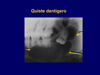 Quiste dentígero
 