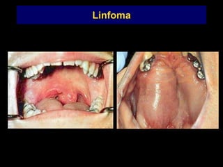 Linfoma
 