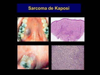Sarcoma de Kaposi
 
