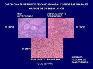 BIEN
DIFERENCIADO
MODERADAMENTE
DIFERENCIADO
POBREMENTE DIFERENCIADO
CARCINOMA EPIDERMOIDE DE CAVIDAD NASAL Y SENOS PARANASALES
GRADOS DE DIFERENCIACIÓN
20 (30%) 14 (22%)
31 (48%)
INSTITUTO
NACIONAL DE
CANCEROLOGIA
TOTAL 65 (100%)
 