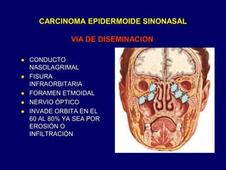 VIA DE DISEMINACION
CARCINOMA EPIDERMOIDE SINONASAL
 CONDUCTO
NASOLAGRIMAL
 FISURA
INFRAORBITARIA
 FORAMEN ETMOIDAL
 NERVIO ÓPTICO
 INVADE ORBITA EN EL
60 AL 80% YA SEA POR
EROSIÓN O
INFILTRACIÓN
 