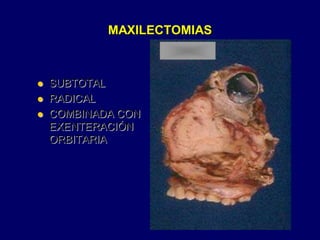 MAXILECTOMIAS
 SUBTOTAL
 RADICAL
 COMBINADA CON
EXENTERACIÓN
ORBITARIA
 