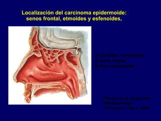 Localización del carcinoma epidermoide:
senos frontal, etmoides y esfenoides,
3) Celdillas etmoidales
4) Seno frontal
5) Seno esfenoidal
3
4
5
Fletcher et al, Diagnostic
Histopathology
of tumours, cap 4, 2000.
 
