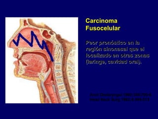 Carcinoma
Fusocelular
Peor pronóstico en la
región sinonasal que el
localizado en otras zonas
(laringe, cavidad oral).
Arch Otolaryngol 1980;106:700-8
Head Neck Surg 1982;4:499-513
 