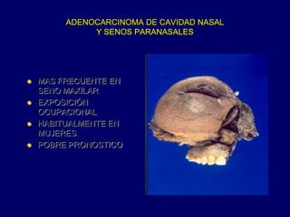 ADENOCARCINOMA DE CAVIDAD NASAL
Y SENOS PARANASALES
 MAS FRECUENTE EN
SENO MAXILAR
 EXPOSICIÓN
OCUPACIONAL
 HABITUALMENTE EN
MUJERES
 POBRE PRONOSTICO
 