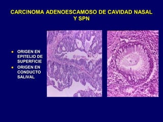 CARCINOMA ADENOESCAMOSO DE CAVIDAD NASAL
Y SPN
 ORIGEN EN
EPITELIO DE
SUPERFICIE
 ORIGEN EN
CONDUCTO
SALIVAL
 