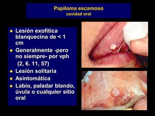 Papiloma escamoso
cavidad oral
 Lesión exofítica
blanquecina de < 1
cm
 Generalmente -pero
no siempre- por vph
(2, 6. 11, 57)
 Lesión solitaria
 Asintomática
 Labio, paladar blando,
úvula o cualquier sitio
oral
 