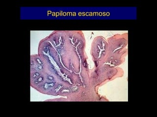 Papiloma escamoso
 