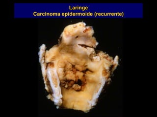 Laringe
Carcinoma epidermoide (recurrente)
 