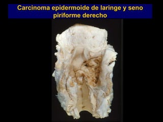 Carcinoma epidermoide de laringe y seno
piriforme derecho
 