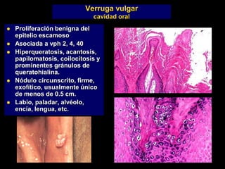 Verruga vulgar
cavidad oral
 Proliferación benigna del
epitelio escamoso
 Asociada a vph 2, 4, 40
 Hiperqueratosis, acantosis,
papilomatosis, coilocitosis y
prominentes gránulos de
queratohialina.
 Nódulo circunscrito, firme,
exofítico, usualmente único
de menos de 0.5 cm.
 Labio, paladar, alvéolo,
encía, lengua, etc.
 