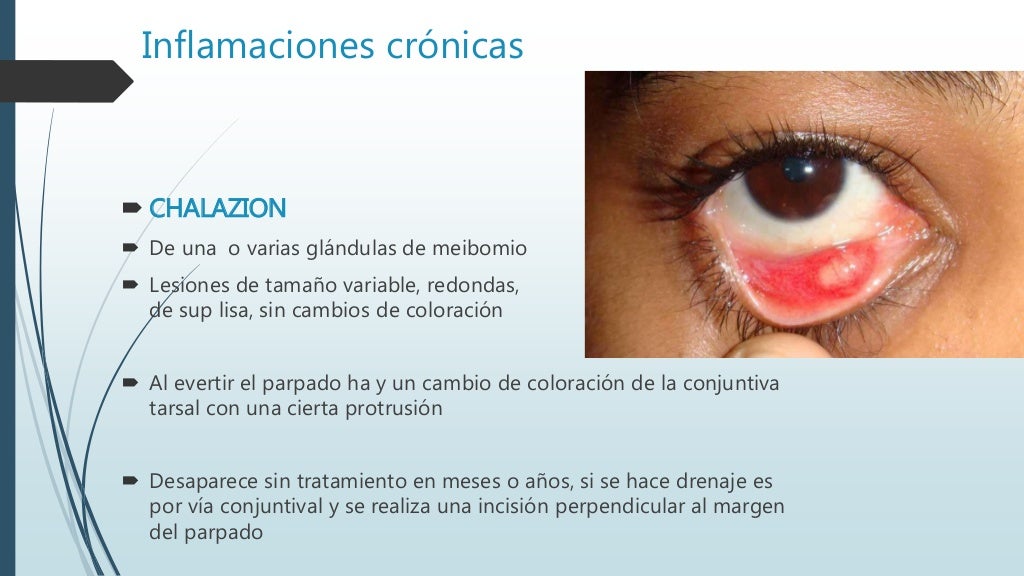 pasar por alto Y Frustración inflamacion glandulas del parpado crítico