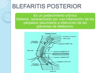 BLEFARITIS POSTERIOR
Es un padecimiento crónico
bilateral, caracterizado por una inflamación de los
párpados secundaria a disfunción de las
glándulas de Meibomio.

 