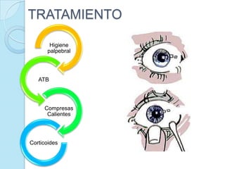 TRATAMIENTO
Higiene
palpebral

ATB

Compresas
Calientes

Corticoides

 