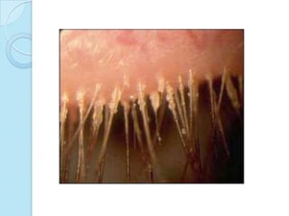 Patología de párpados. Blefaritis
