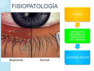 FISIOPATOLOGÍA
CAUSAS

DERMATITIS
SEBORREICA,
INFECCIÓN
BACTERIANA

ALERGIAS, PIOJOS

 