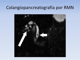 Colangiopancreatografia por RMN
 