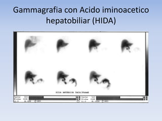 Gammagrafia con Acido iminoacetico
hepatobiliar (HIDA)
 